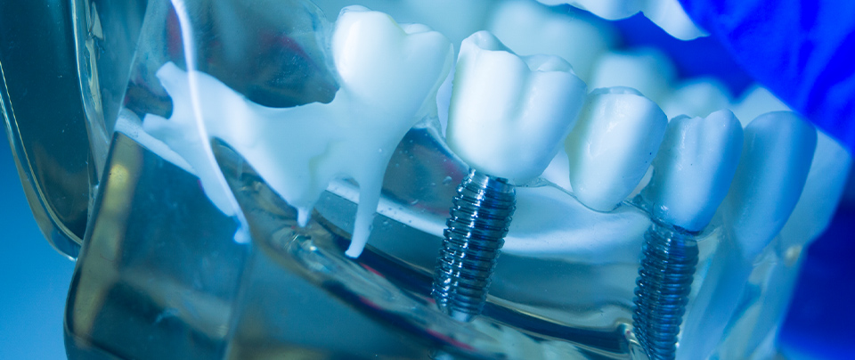 All-on-4（オールオン4）